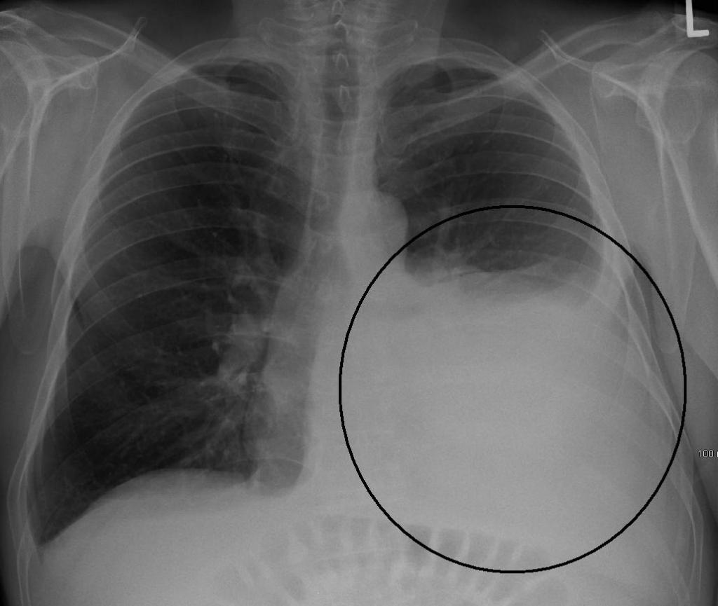 Ambulatoryjny standard leczenia zapalenia płuc